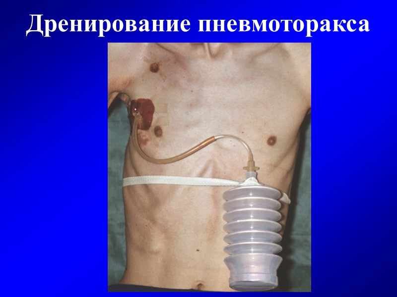 Дренирование пневмоторакса